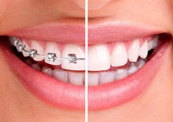 Orthodontie et Hygiène Bucco-dentaire