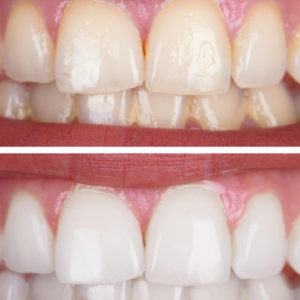 Dentisterie Esthétique avec un nouvel équipement