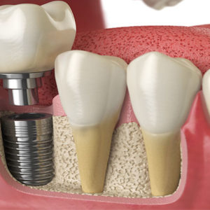Installation d’implants