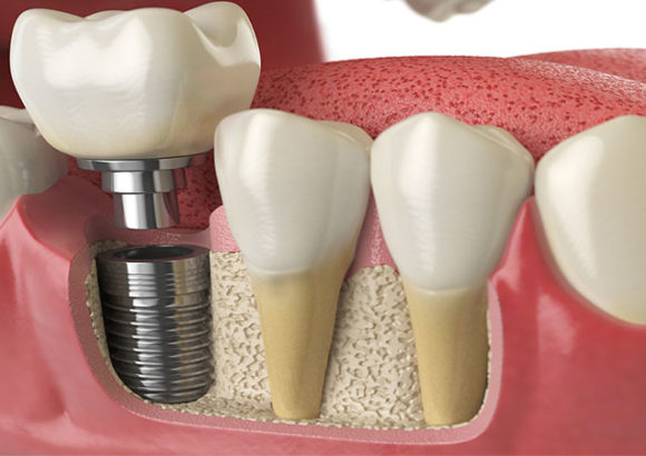 Installation d’implants