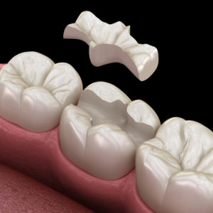 Traitement des caries dentaires. Nouvelle pratique
