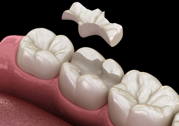 Traitement des caries dentaires. Nouvelle pratique
